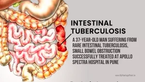 rare-intestinal-tuberculosis-small-bowel-obstruction-successfully-treated-at-apollo-spectra-hospital-in-pune